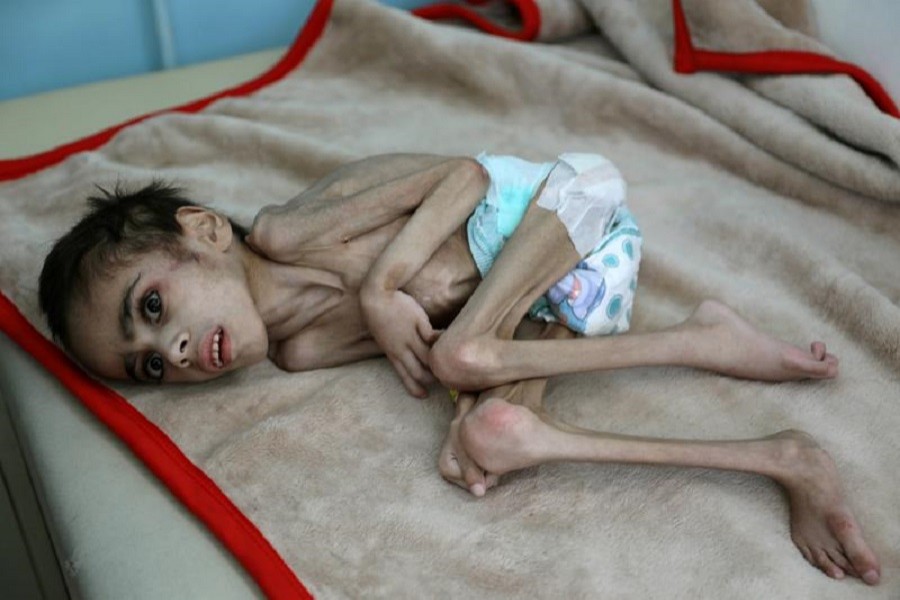 Ravaged by war, Yemeni boy weighs 7kg