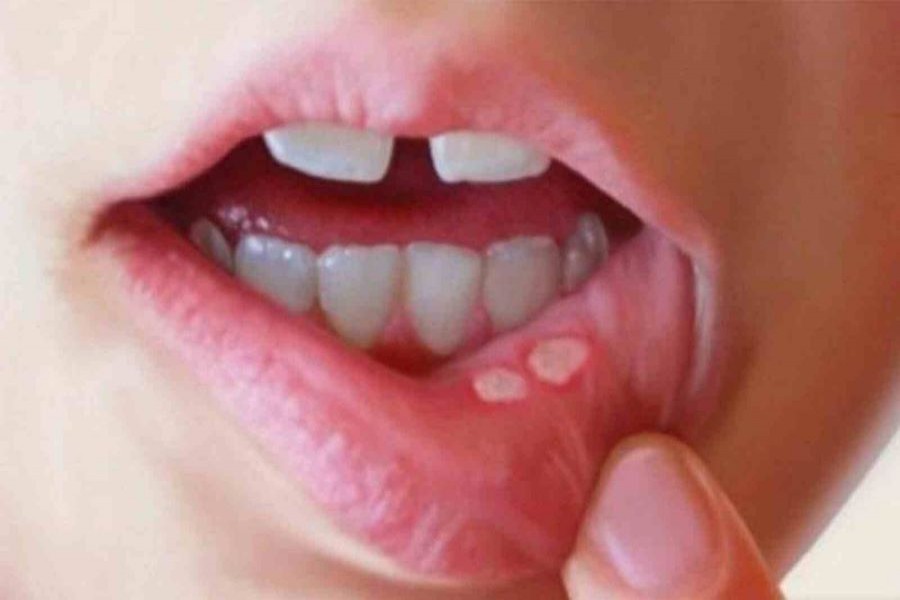 মুখে ঘা যেসব রোগের ইঙ্গিত দেয়