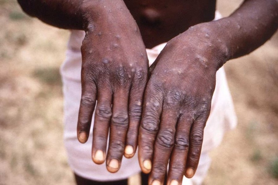 গায়ে হঠাৎ ফুসকুড়ি? মাঙ্কিপক্স না অন্যকিছু?