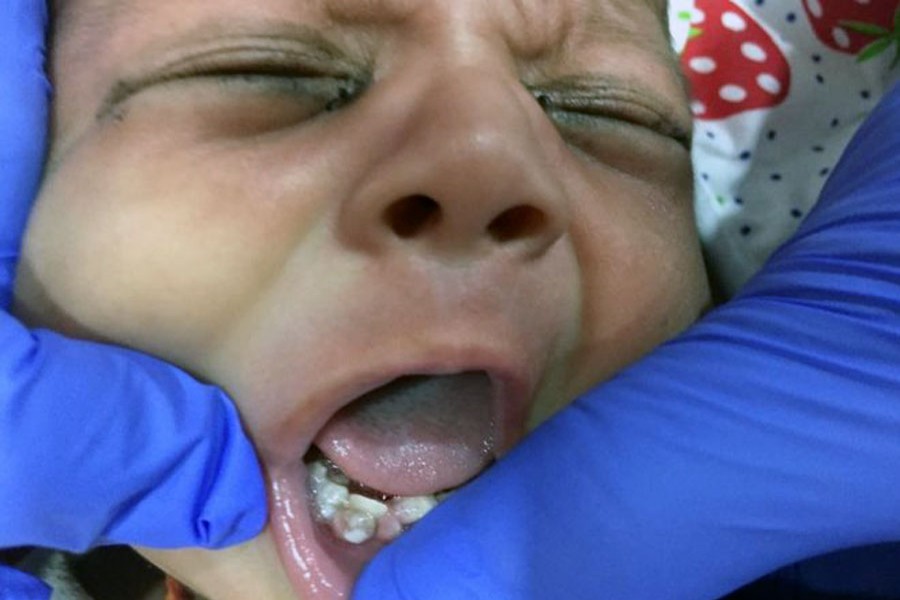 India doctors remove seven teeth from infant