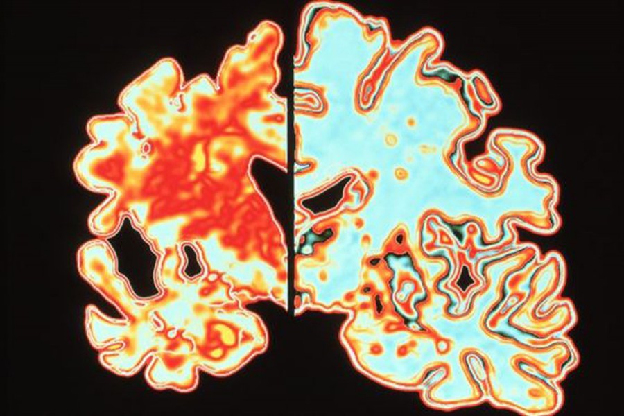 A medical scan shows Alzheimer's disease brain (left) compared to normal (right). Source: BBC