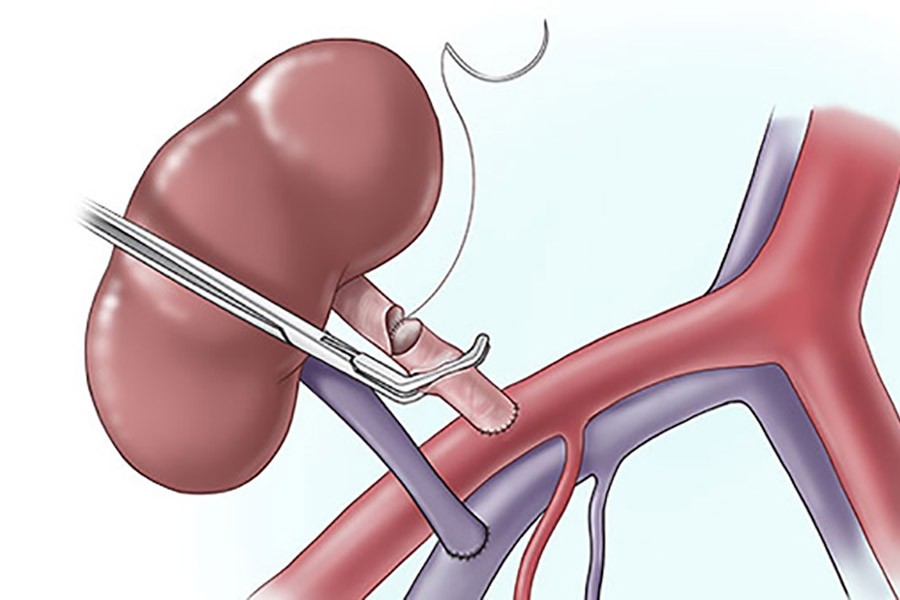 BD awaits donors for first-ever kidney transplant from brain-dead