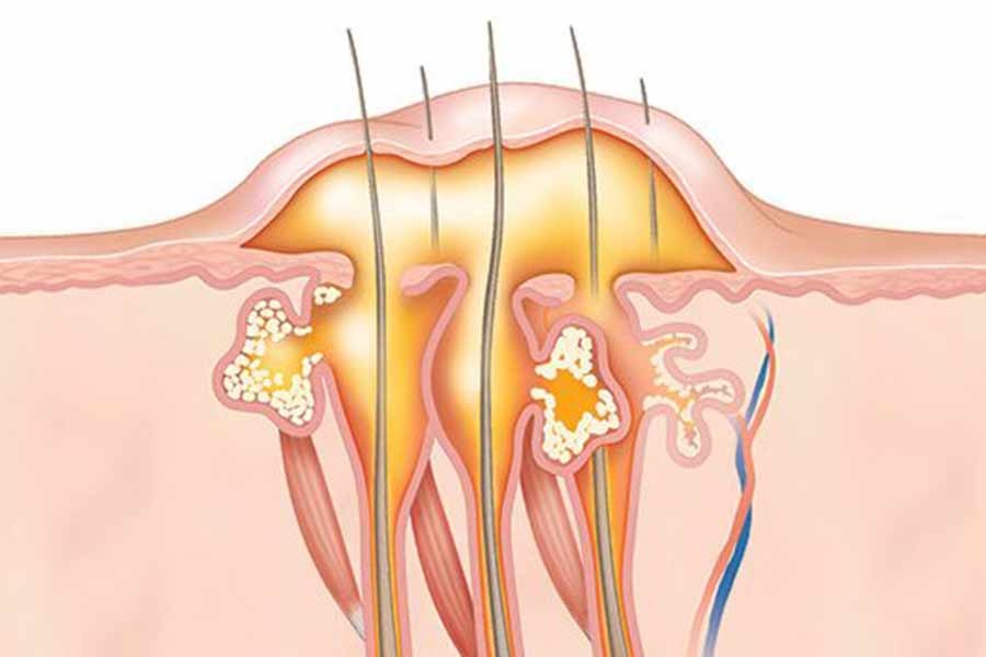 Boils: Why and how to deal with it