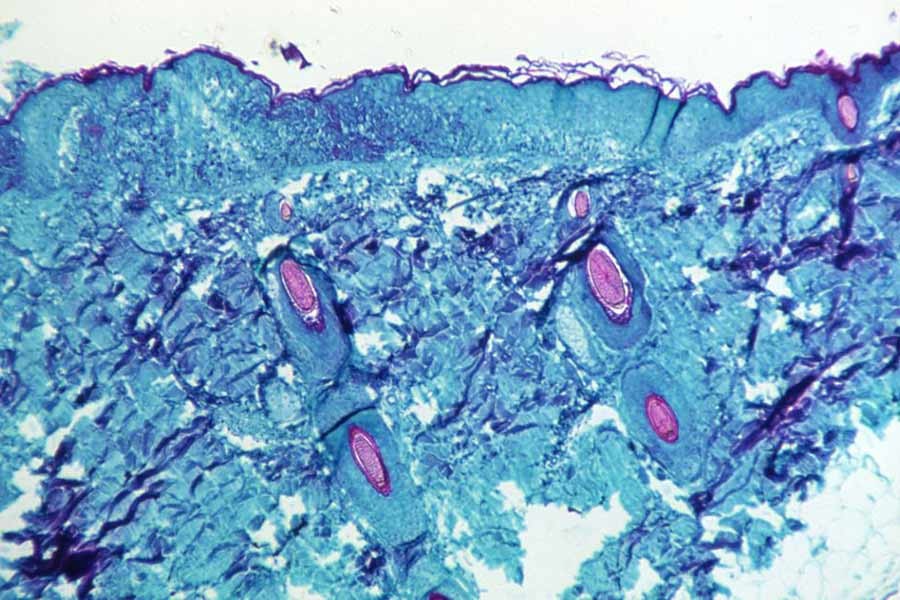 A section of skin tissue, harvested from a lesion on the skin of a monkey, which was infected with monkeypox virus, is seen at 50X magnification on day four of rash development in 1968.