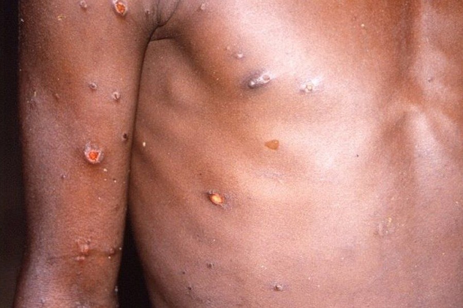 Monkeypox: 80 cases confirmed in 12 countries