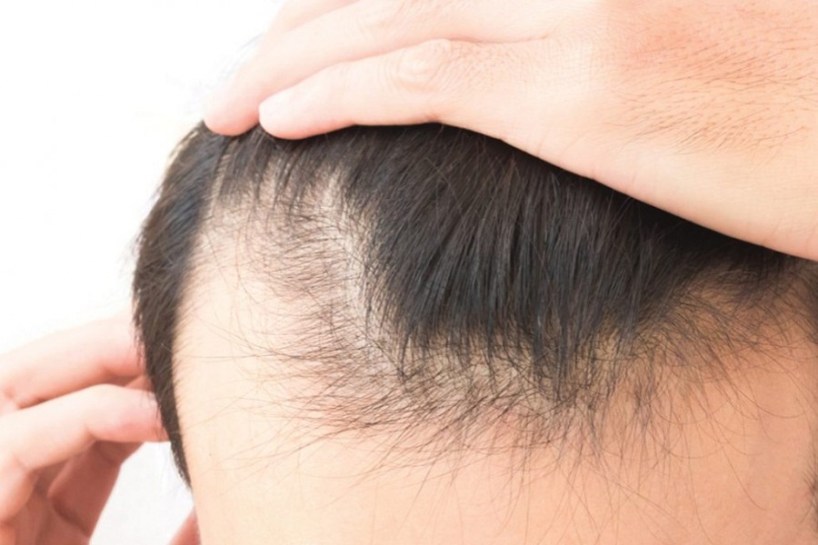 Hair loss triggered by COVID-19 treatment: What's the solution?