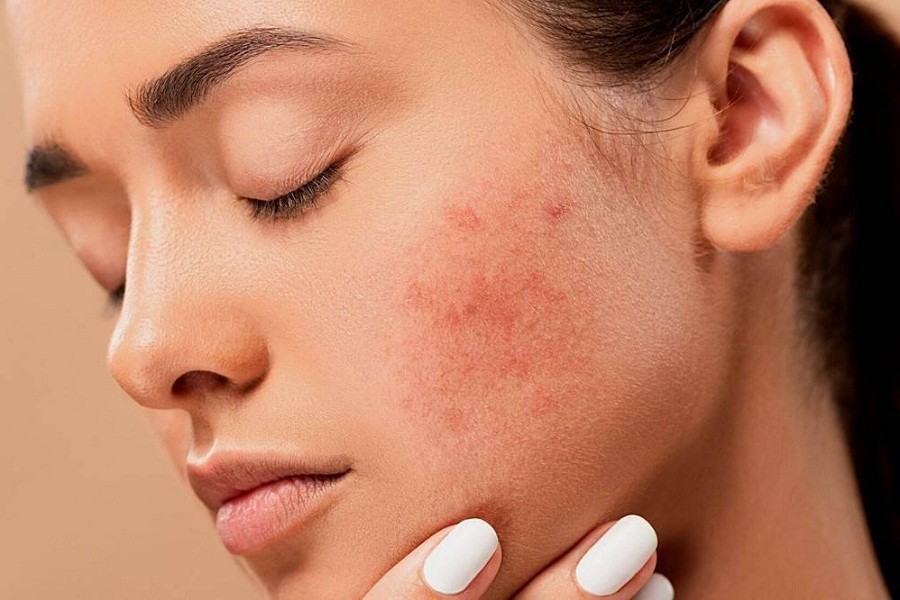 Managing teenage acne problems